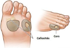 le cal et la corne sous les pieds