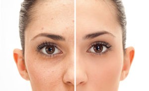 verrue visage huile essentielle