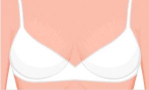 vergetures sur les seins vergetures sur les seins