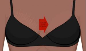 vergetures seins grossesse vergetures seins grossesse