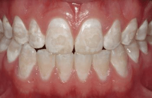 taches blanches sur les dents calcium