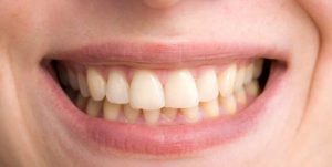 taches blanches sur les dents grossesse