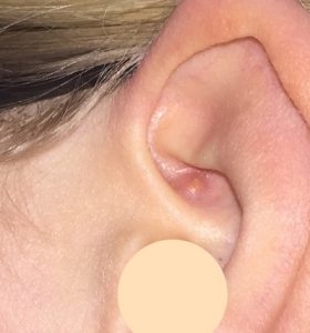 boutons dans l'oreille