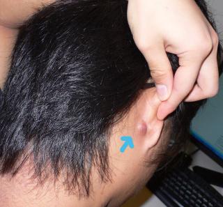 boule derrière l'oreille