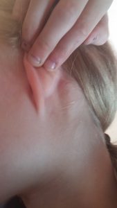 boule dure derrière l'oreille