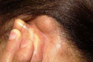 petite boule derrière l'oreille