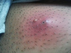 poils incarnés sur les jambes