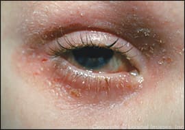 eczéma des paupières