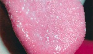 boutons sur la langue boutons sur la langue