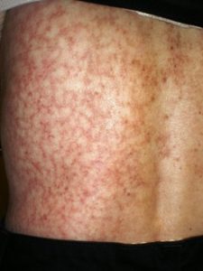 peau marbrée peau marbrée