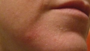 peau sèche qui pèle peau sèche qui pèle