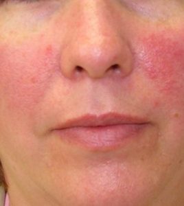 traiter les plaques rouges du visage soigner les plaques rouges du visage