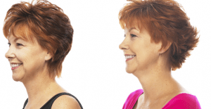 facial-flex avant après image