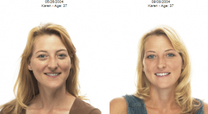 facial-flex photos avant après	
