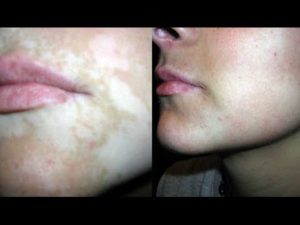 avis sur protopic pour le vitiligo