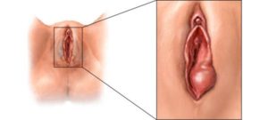 boutons sur la vulve boutons sur la vulve