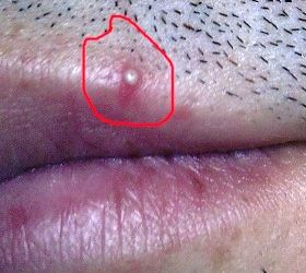 points blancs sur les lèvres de la bouche