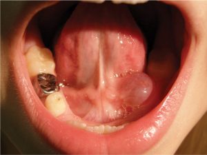 boule sous la langue